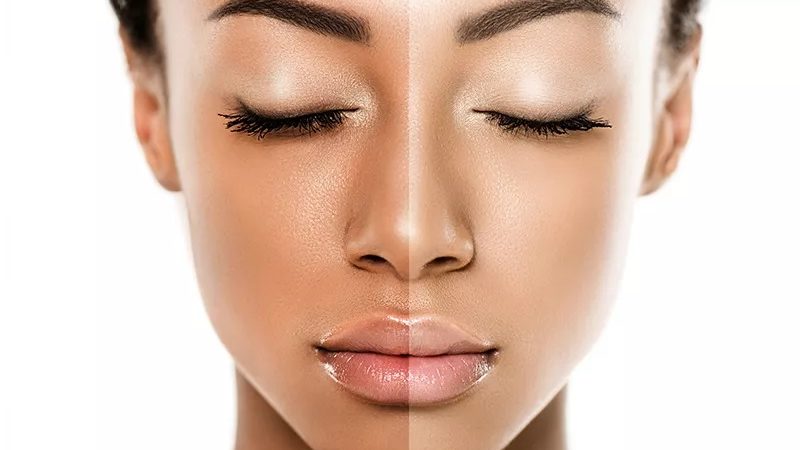 Darker Skin Women – Which cosmetic treatment they should choose?
