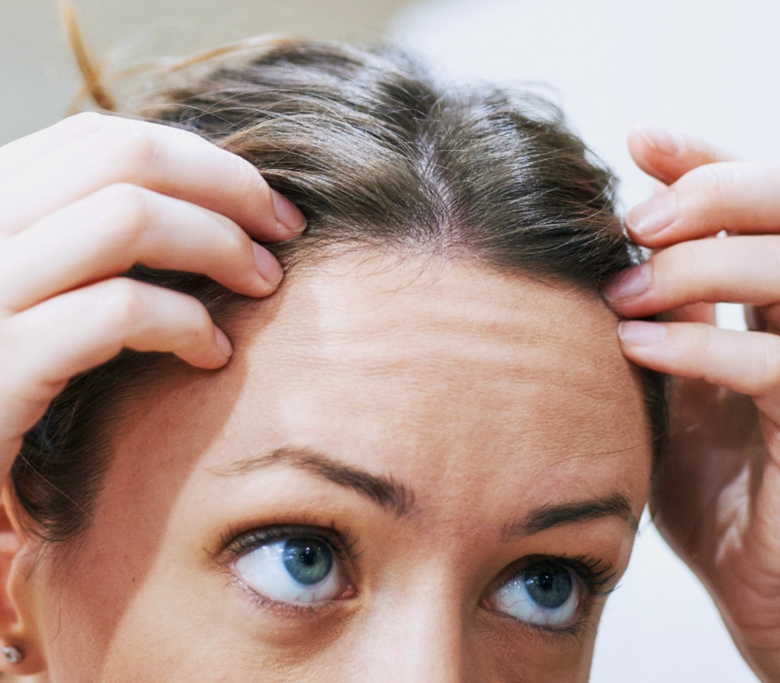 Menopause, Hair Loss, and Too Much Estrogen