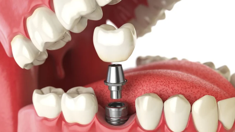 Implant vs. Bridge: Making the Right Choice for Tooth Replacement in Ottawa
