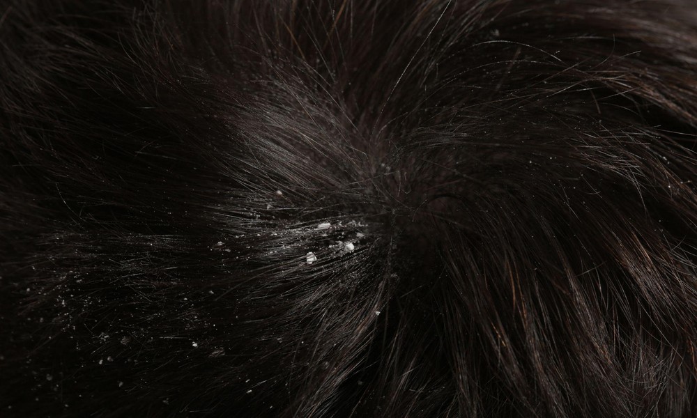 The Connection Between Dandruff Build-Up and Hair Fall